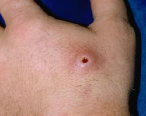Ảnh 4 của Puncture Wound