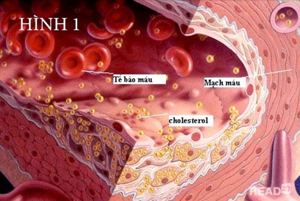 Ảnh 3 của Cholesterol máu cao
