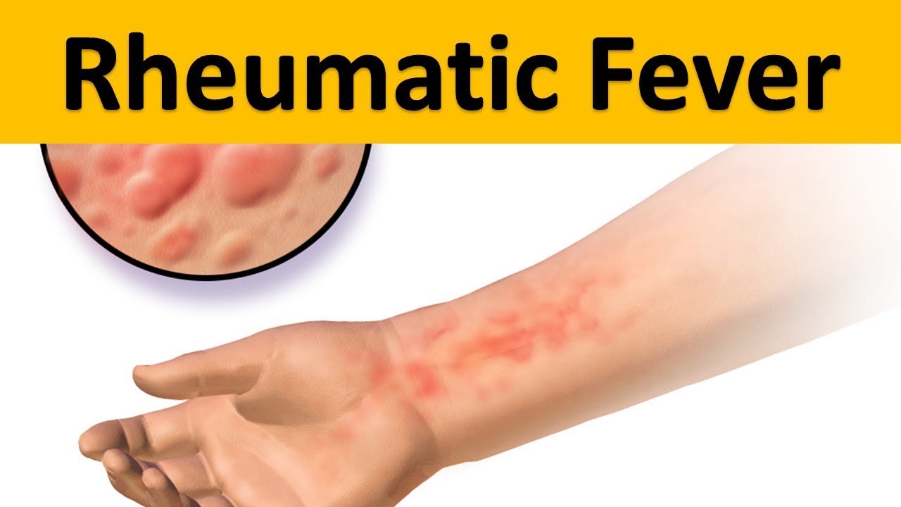 Ảnh 4 của Rheumatic fever