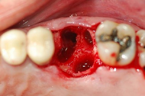 Bệnh Sâu răng: Nguyên nhân, biến chứng và cách điều trị