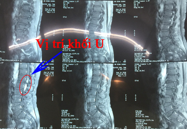 Ảnh 1 của Spinal Cord Tumor