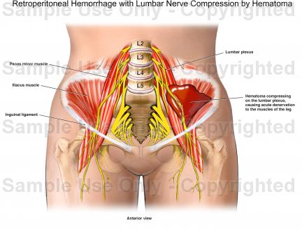 Ảnh 1 của Retroperitoneal hemorrhage