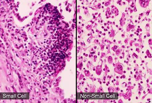 Ảnh 1 của Small-cell Carcinoma