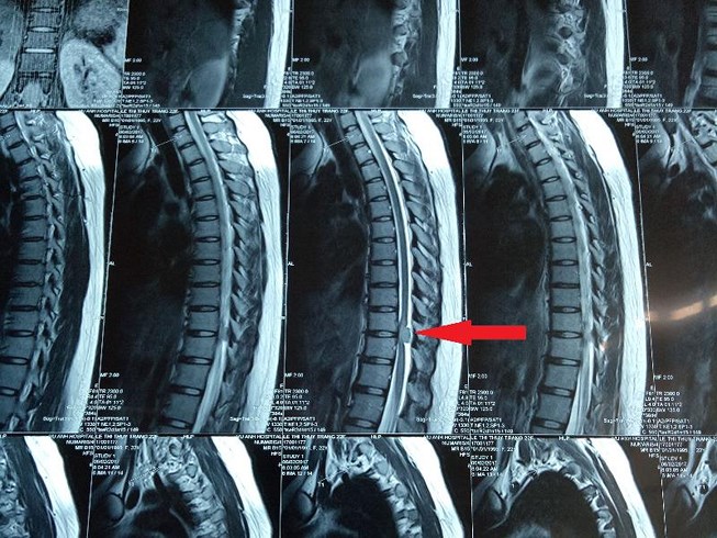 Ảnh 2 của Spinal Cord Tumor