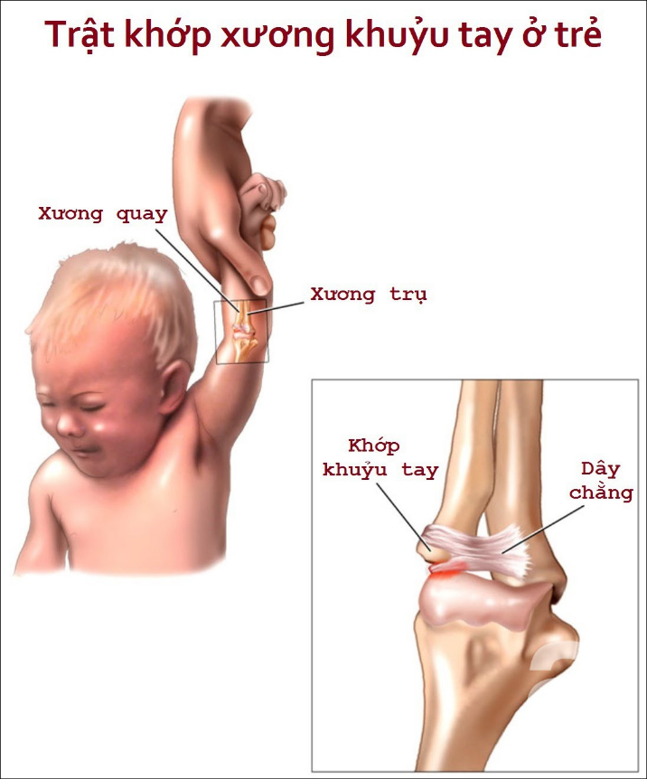 Ảnh 4 của Sai khớp đầu xương quay ở trẻ em
