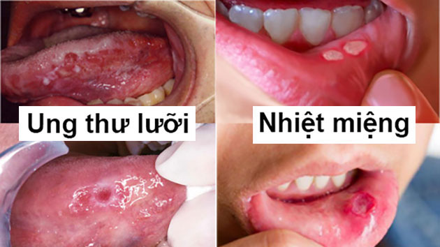 Ảnh 1 của Tongue cancer