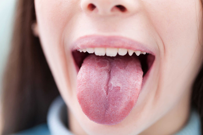 Ảnh 2 của Tongue cancer