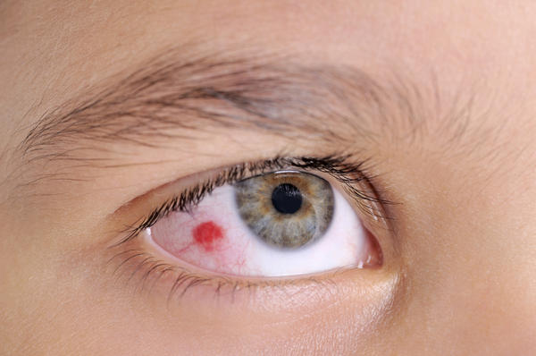 Ảnh 3 của Tụ máu mắt sau chấn thương