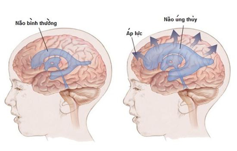 Bệnh Tràn dịch não: Nguyên nhân, biến chứng và cách điều trị