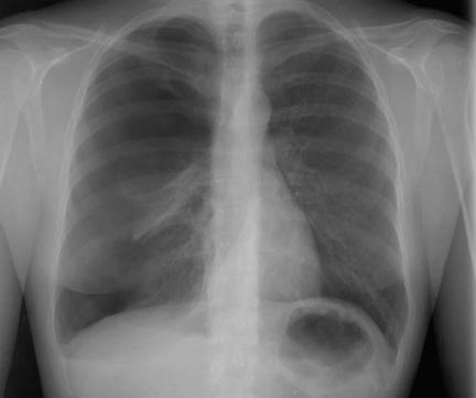 Ảnh 3 của Tràn khí màng phổi áp lực