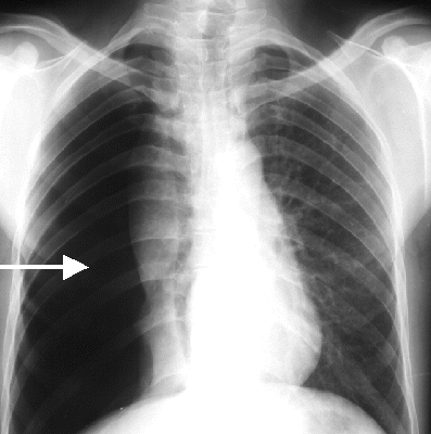 Ảnh 2 của Tràn khí màng phổi áp lực