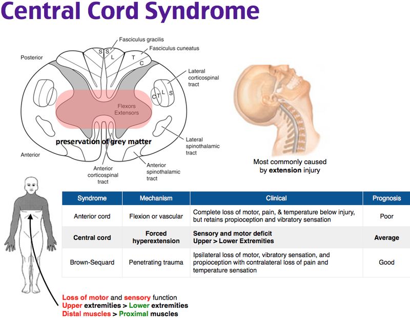 Ảnh 2 của Central Cord Syndrome