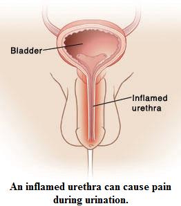 Ảnh 3 của Urethritis