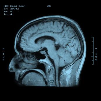 Ảnh 1 của Tắc động mạch tiểu não dưới sau (đột quỵ)