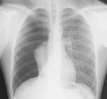 Ảnh 4 của Tràn khí màng phổi áp lực