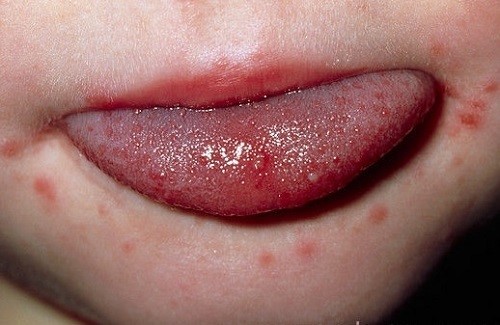 Ảnh 2 của Viêm miệng do virus Herpes