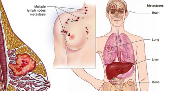 Ảnh 1 của Ung thư biểu mô tuyến vú xâm lấn (IDC)