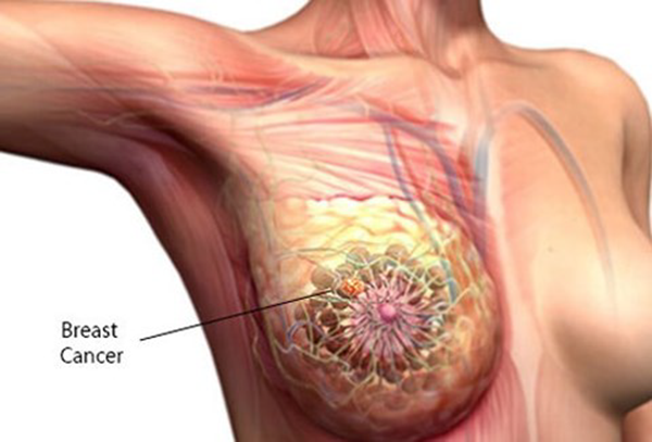 Ảnh 2 của Ung thư biểu mô tuyến vú xâm lấn (IDC)