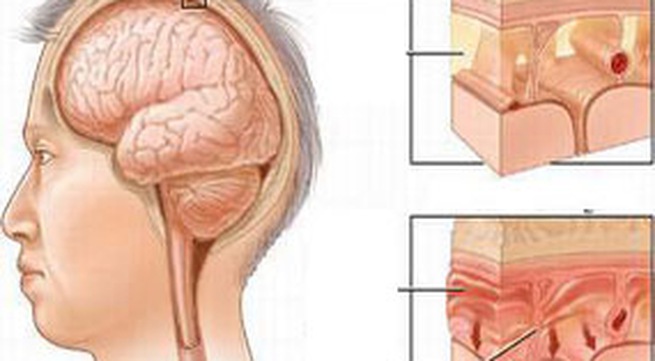 Bệnh Viêm màng não: Nguyên nhân, biến chứng và cách điều trị