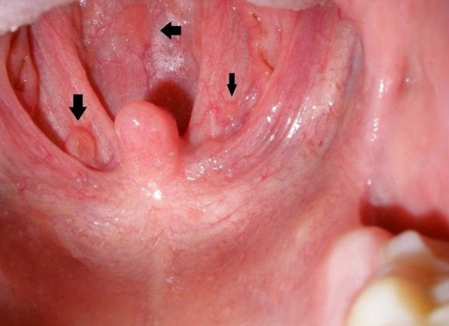 Ảnh 2 của Ung thư miệng (Ung thư hầu họng)