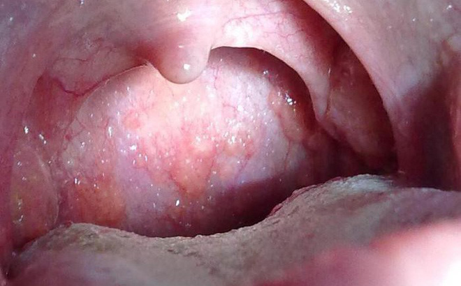 Ảnh 3 của Ung thư miệng (Ung thư hầu họng)