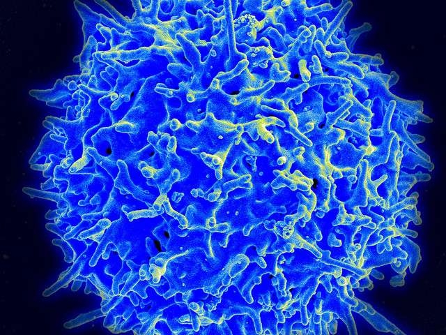 Ảnh 4 của U lympho tế bào T