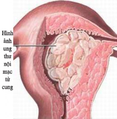 Ảnh 4 của Ung thư nội mạc tử cung