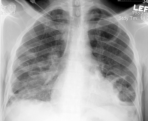Ảnh 1 của Viêm phổi do tụ cầu