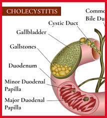 Ảnh 1 của Cholecystitis