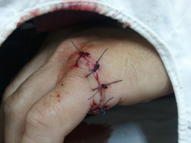 Ảnh 2 của Vết thương thủng ở ngón tay
