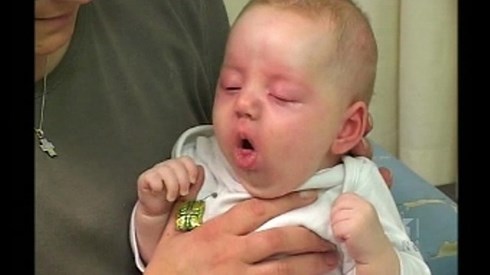 Ảnh 2 của Whooping cough