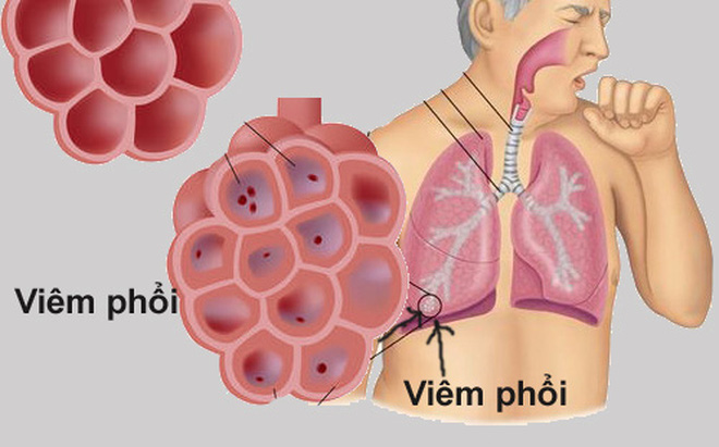 Ảnh 1 của Viêm phổi do vi-rút