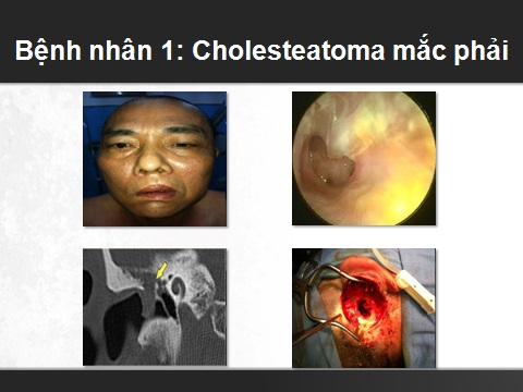 Ảnh 2 của Viêm tai cholesteatoma