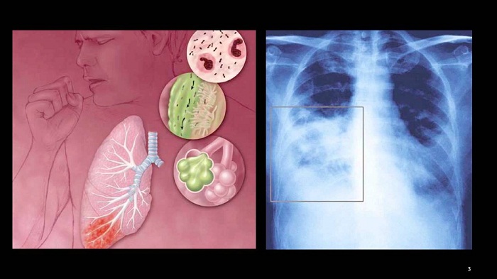Ảnh 3 của Viêm phổi do vi-rút