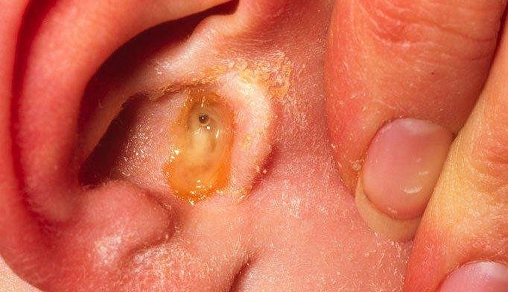 Ảnh 4 của Viêm tai cholesteatoma