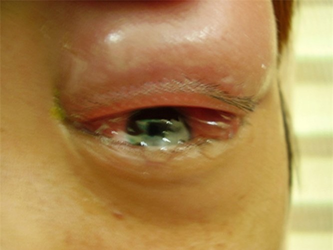 Ảnh 4 của Viêm tế bào ổ mắt