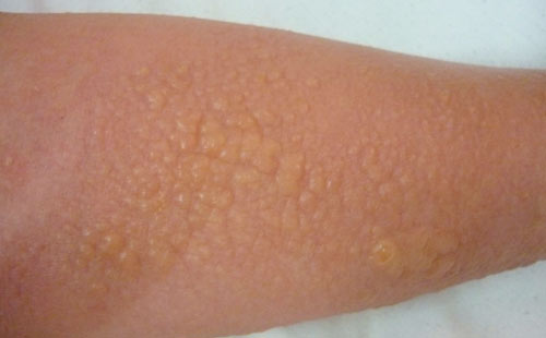 Bệnh Rộp da: Nguyên nhân, biến chứng và cách điều trị
