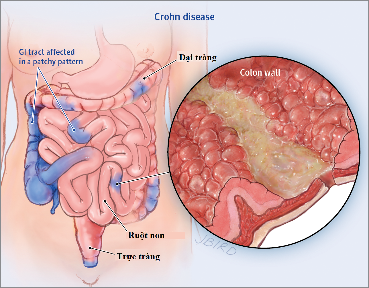 Cắt bỏ ruột điều trị bệnh Crohn là gì? - quy trình thực hiện và hồi phục sức khỏe