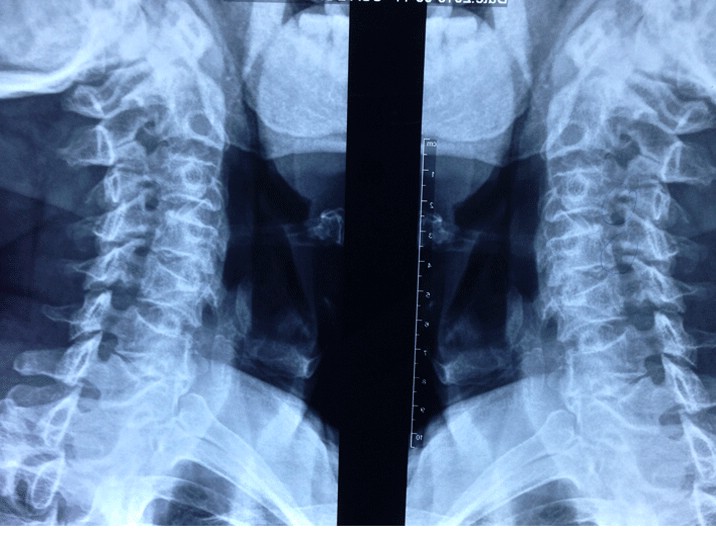 X-quang cột sống cổ chẩn đoán bệnh gì? và hướng dẫn đọc kết quả