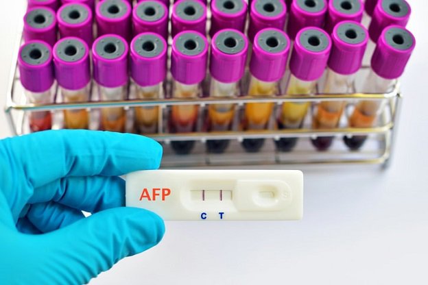 Xét nghiệm Alpha-fetoprotein (AFP) chẩn đoán bệnh gì? và hướng dẫn đọc kết quả
