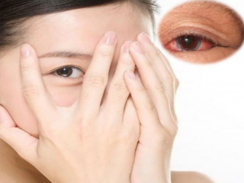 Viêm giác mạc: Nguyên nhân, triệu chứng, cách phòng tránh