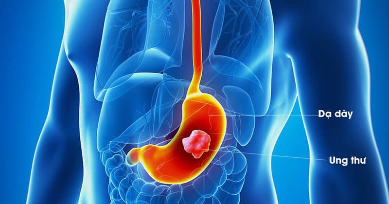Các phương pháp điều trị ung thư dạ dày hiệu quả