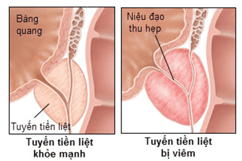 Dấu hiệu của bệnh viêm tiền liệt tuyến ở nam giới