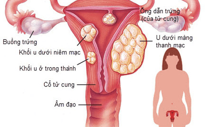U xơ tử cung ác tính là gì? Cách điều trị