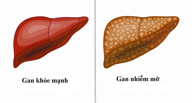 Gan nhiễm mỡ cấp độ 2 Những điều cần biết