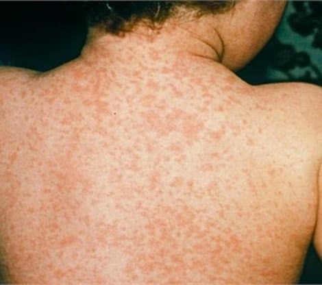 Rubella là bệnh gì? Nguyên nhân, triệu chứng, biến chứng và cách đề phòng