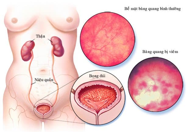 Viêm bàng quang cấp có nguy hiểm không?