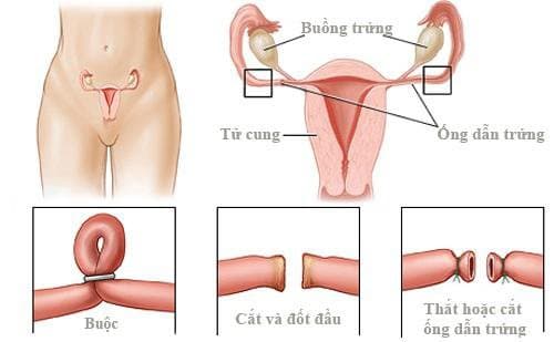 Nối ống dẫn trứng để tiếp tục sinh con được không?