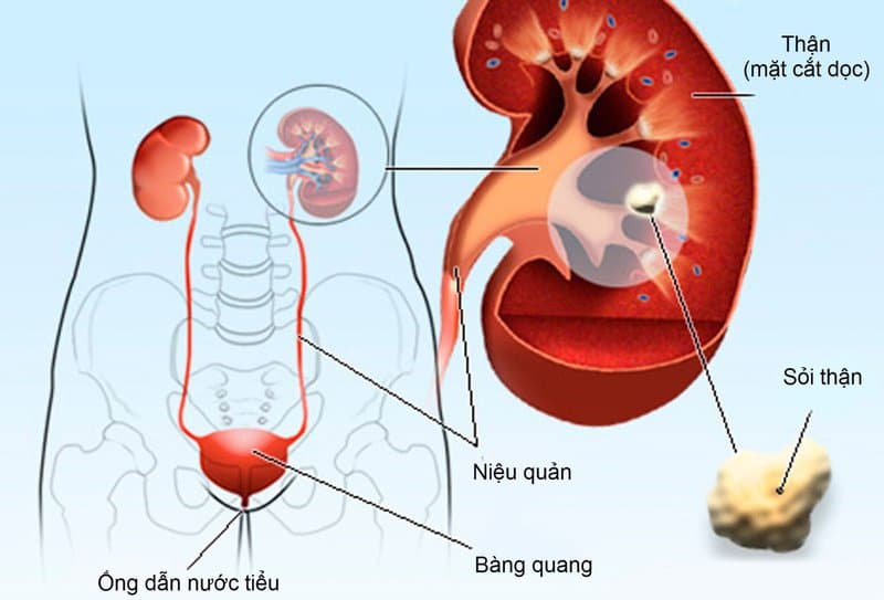 Sỏi thận hình thành như thế nào?