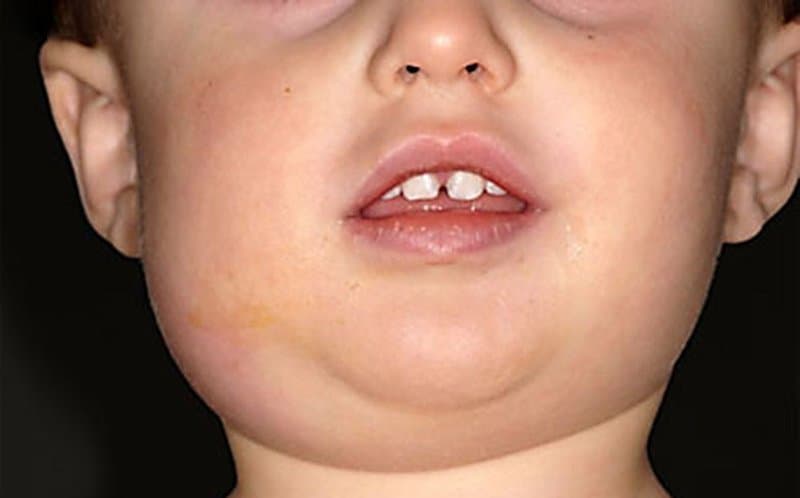 Bệnh quai bị: Nguyên nhân, triệu chứng, biến chứng và cách phòng ngừa